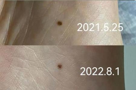 男人脚痣相算命图解