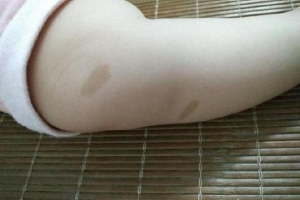 胎记算命：如何看胎记算命