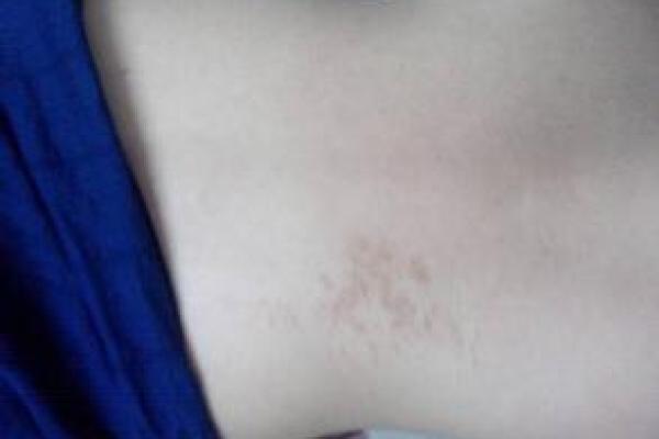 腿部不同位置的胎记算命分析-