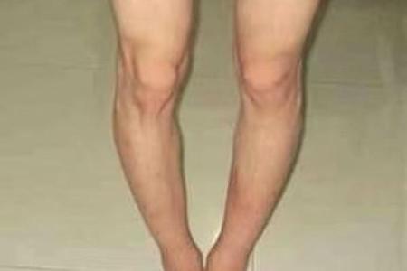 八字型腿