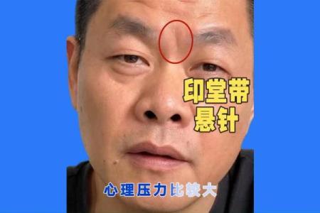 印堂八字纹的男人面相婚姻