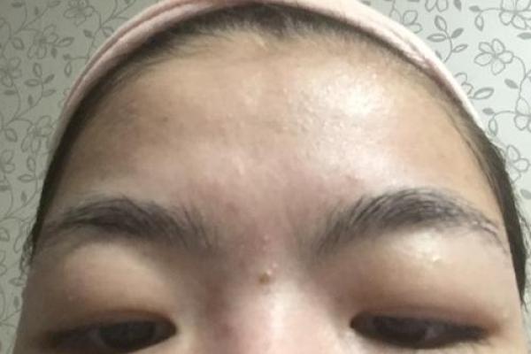 眉心突然出现八字，原因及应对措施全揭秘！