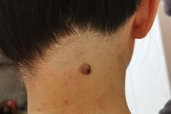 脖子痣看相算命吉凶