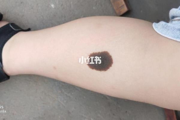 腿上有胎记算命分析
