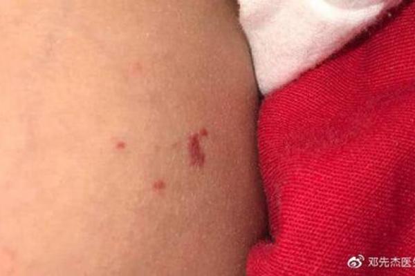 红色的胎记算命 红色的胎记算命