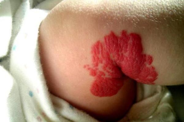 红色的胎记算命 红色的胎记算命