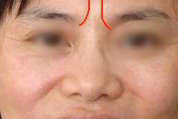 八字皱纹