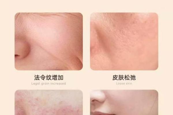 眉间八字纹消除